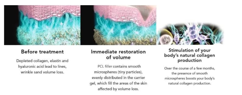Relleno de policaprolactona