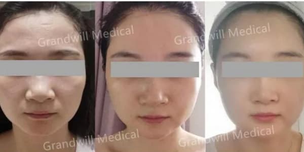 Relleno de policaprolactona